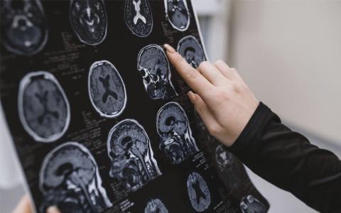 Cada año se diagnostican en España unos 40.000 nuevos casos de alzhéimer.