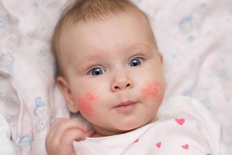 En algunos países la dermatitis atópica afecta al 20% de los menores.
